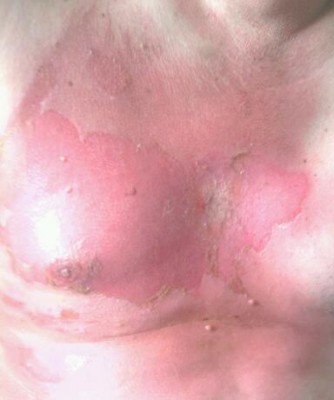 Burns I suffered last Weds.